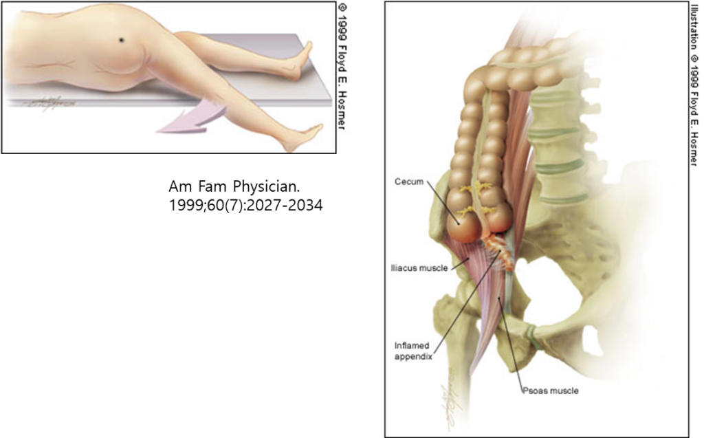 복통-Psoas sign