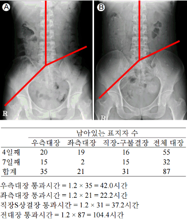 만성변비