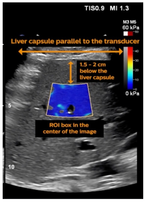 shear wave elastography