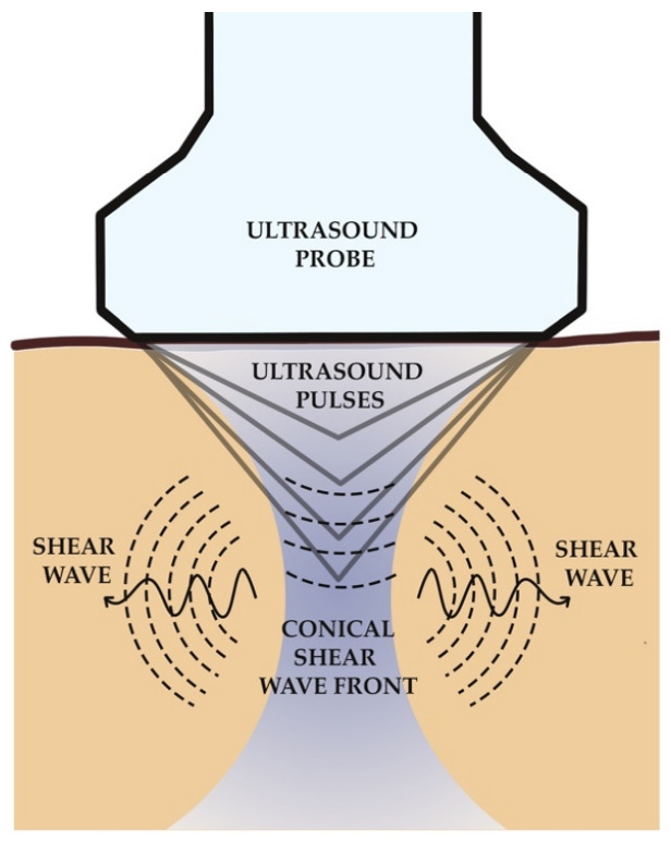 shear wave elastography