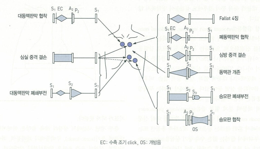 심잡음