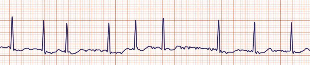 Irregular rhythm