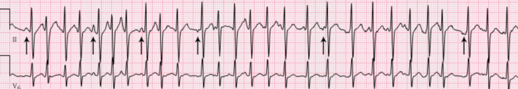 Irregular rhythm