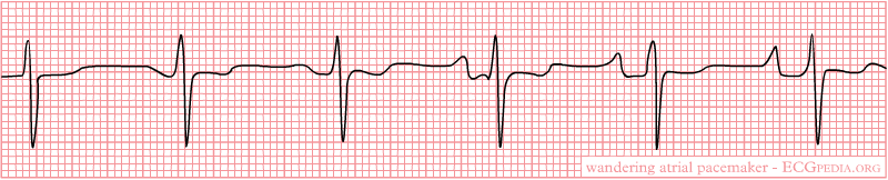 Irregular rhythm