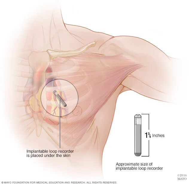 이식형 심장 사건 기록기 (Implantable loop recorder)