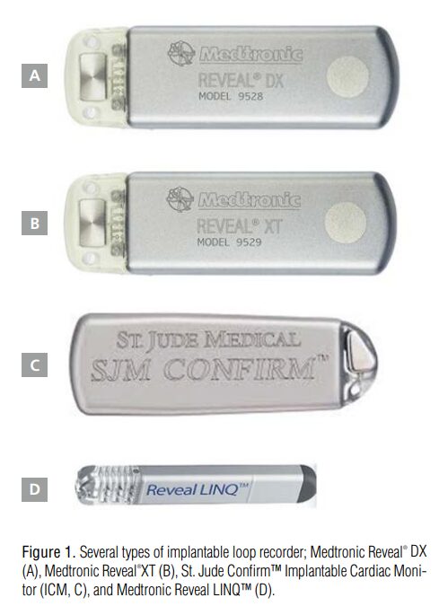 이식형 심장 사건 기록기 (Implantable loop recorder)