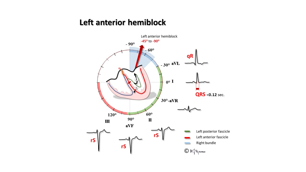 LBBB (좌각차단, Left bundle branch) 의 심전도 기준 (feat. LAFB, LPFB) - 손닥터닷컴