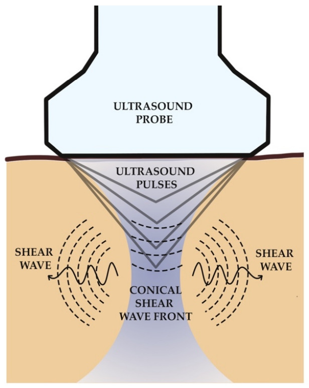 shear wave elastography